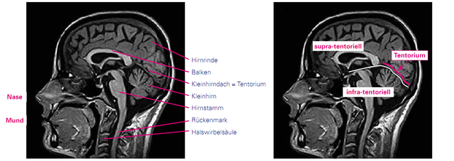 Kernspin des Kopfes seitlich T1 Sequenz